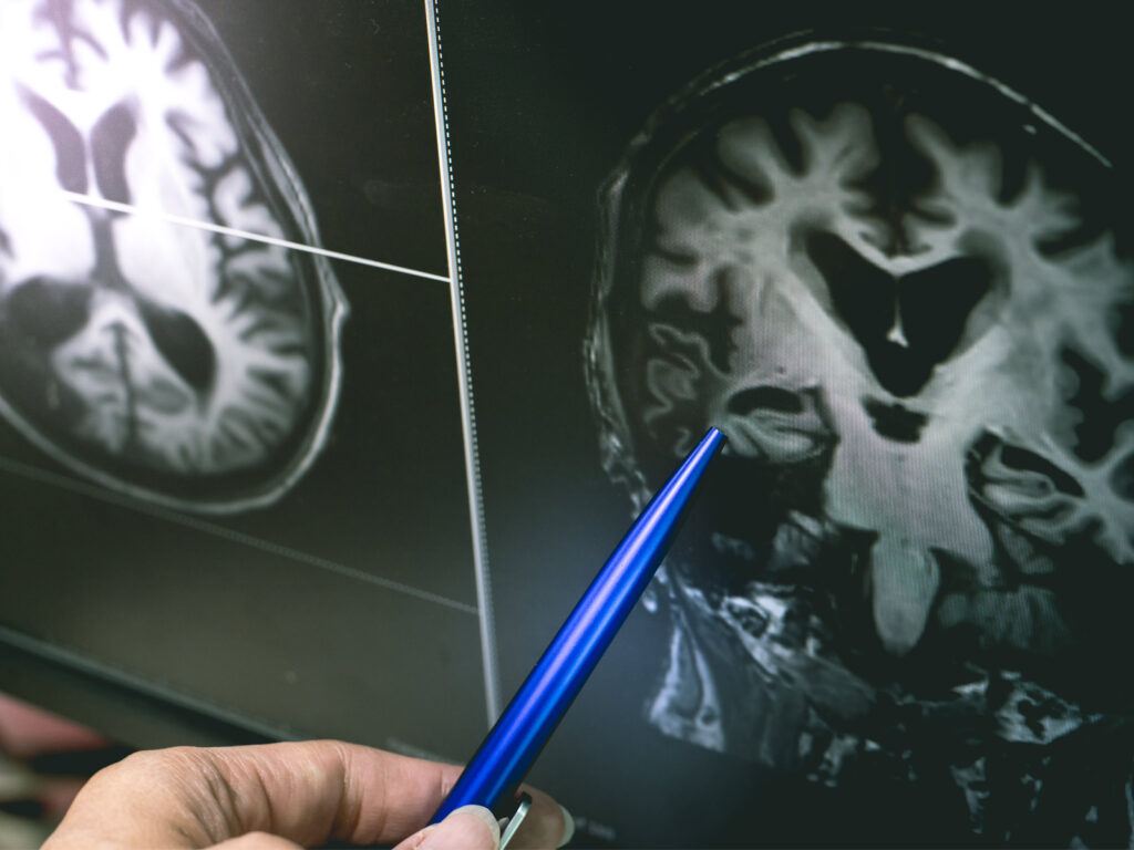 Could Alzheimer’s Be Caused by a Microbe?